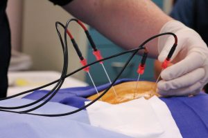 Sacroiliac Joint Radiofrequency Ablation - Spine & Orthopaedic Centre