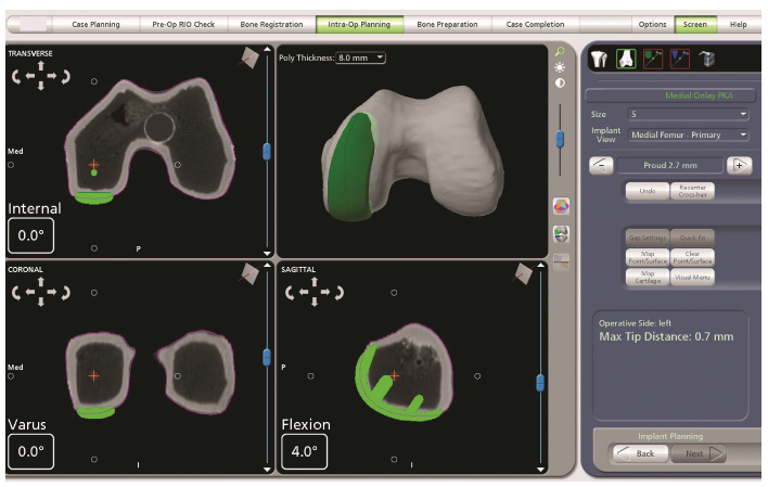 Robotic partial knee replacement planning